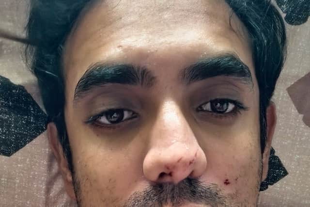 Mridhul Kombara, after the injury.