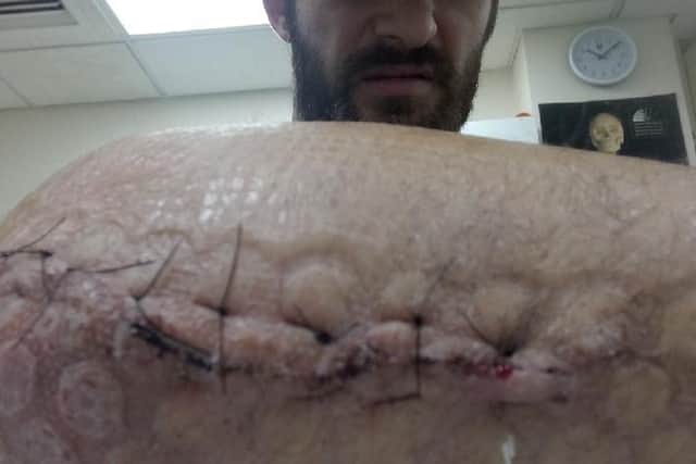 Stitches after the operation