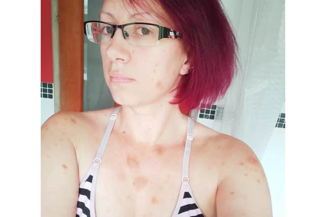 The marks on her skin made Becki suspect she had lymphoma