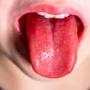 Tongue of a child with scarlet fever (Lukassek - stock.adobe.com)