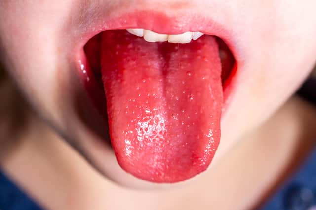Tongue of a child with scarlet fever (Lukassek - stock.adobe.com)