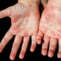 Symptoms of scarlet fever include a sandpapery skin rash