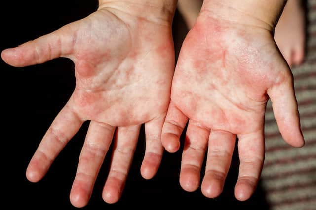 Symptoms of scarlet fever include a sandpapery skin rash