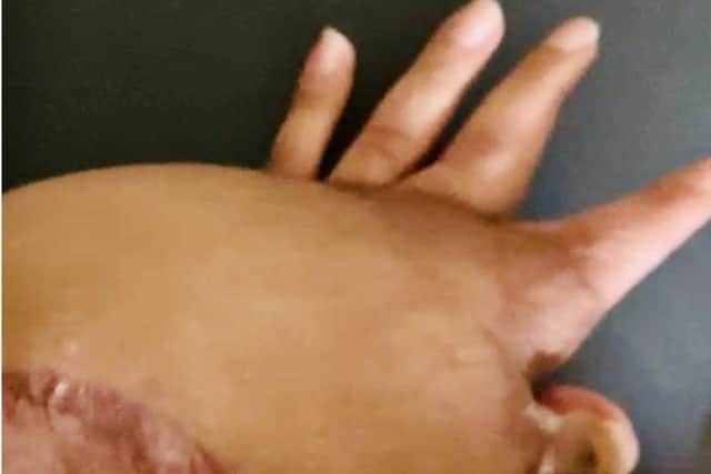Shenila injured her arm in recent years