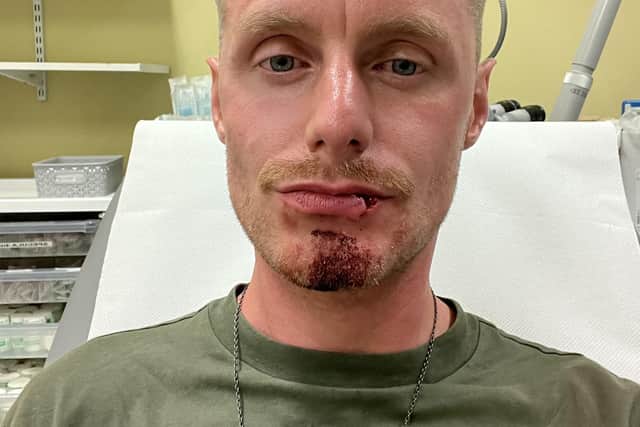 Michael Smith who had his lip split open during the assault