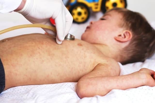 Measles is a highly infectious viral illness, which can sometimes lead to serious complications (Photo: Shutterstock)
