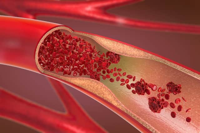A buildup of plaque in your arteries ultimately makes your arteries much narrower and stiffer. (Shutterstock)