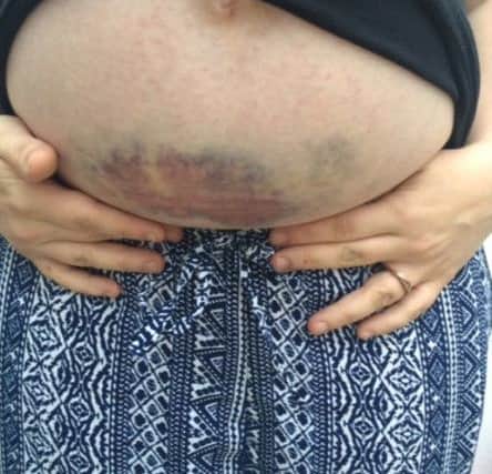 The bruises on Jennifer's pregnant tummy